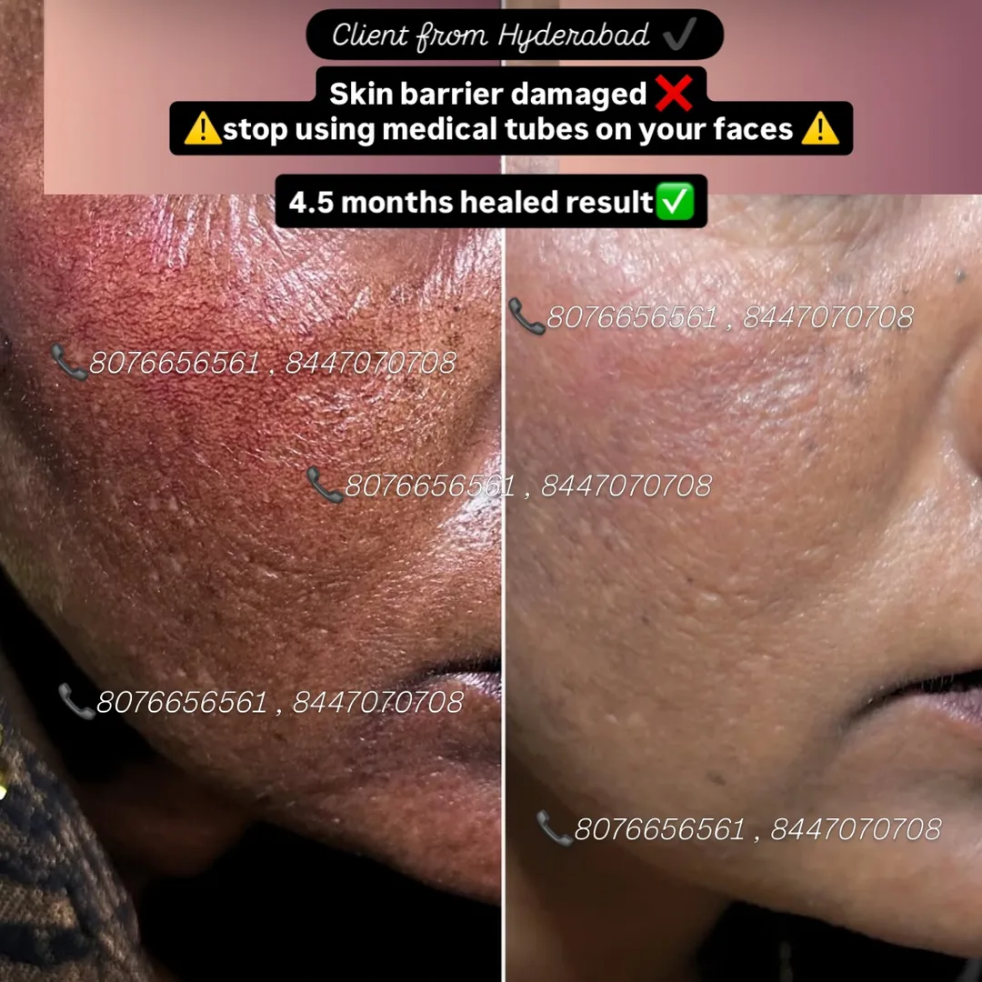 Skin barrier repair — before and after